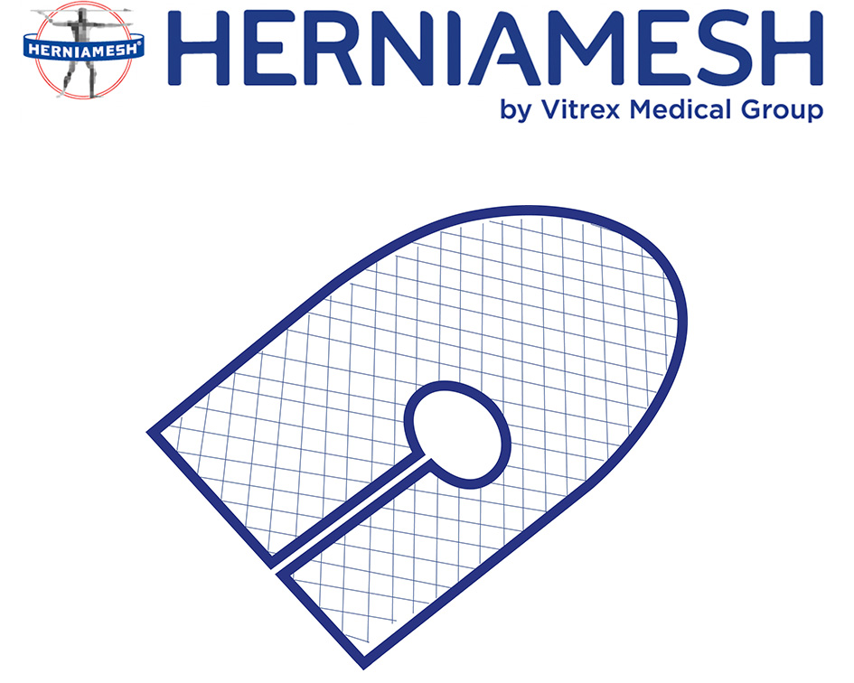 Surgical meshes patches for abdominal hernia. Abdominal hernioplasty.